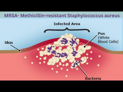 What is MRSA?  Methicillin Resistant Staphylococcus Aureus