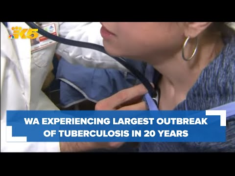 Washington experiencing largest tuberculosis outbreak in 20 ...