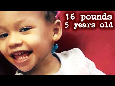 16 Pounds At 5 Years Old: The Sickening Case of Cali Anderson