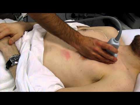 San RNS Ultrasound SHOCK algorithm.MOV