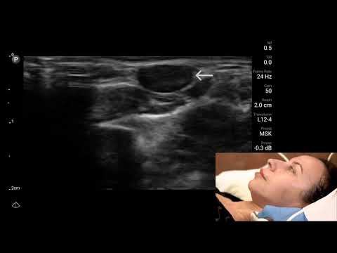 Botulinum Toxin Injections - Part 2