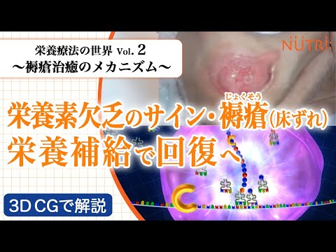 栄養学科 栄養療法の世界Vol.2　褥瘡治癒のメカニズム〈3D CG解説〉－栄養素欠乏のサイン・褥瘡（床ずれ）栄養補給で回復へ－
