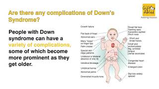 Down's Syndrome