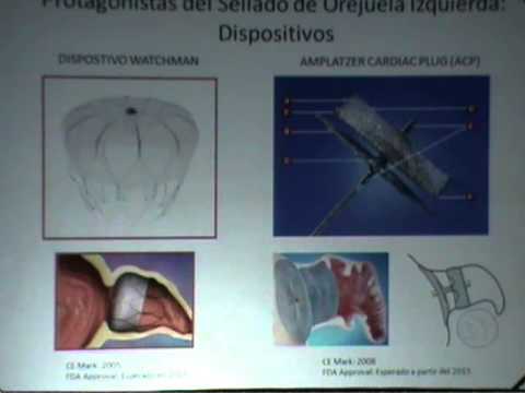 Cierre endovascular de orejuela izquierda