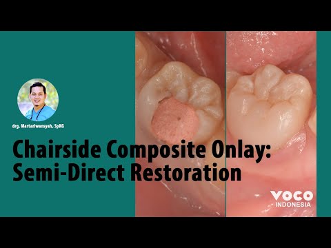 Composite Onlay: Semi-Direct Restoration