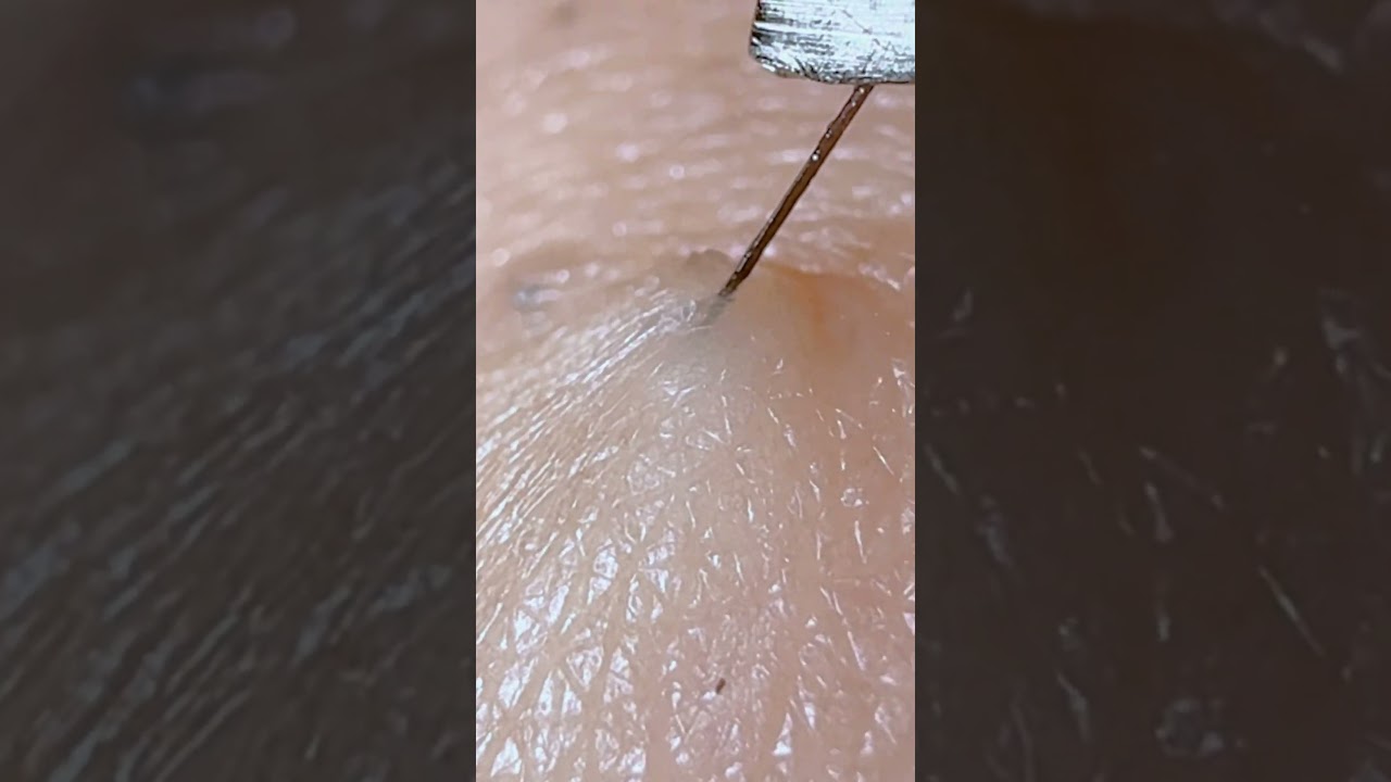 手ブレひどくてすまん#hairpick #毛抜き