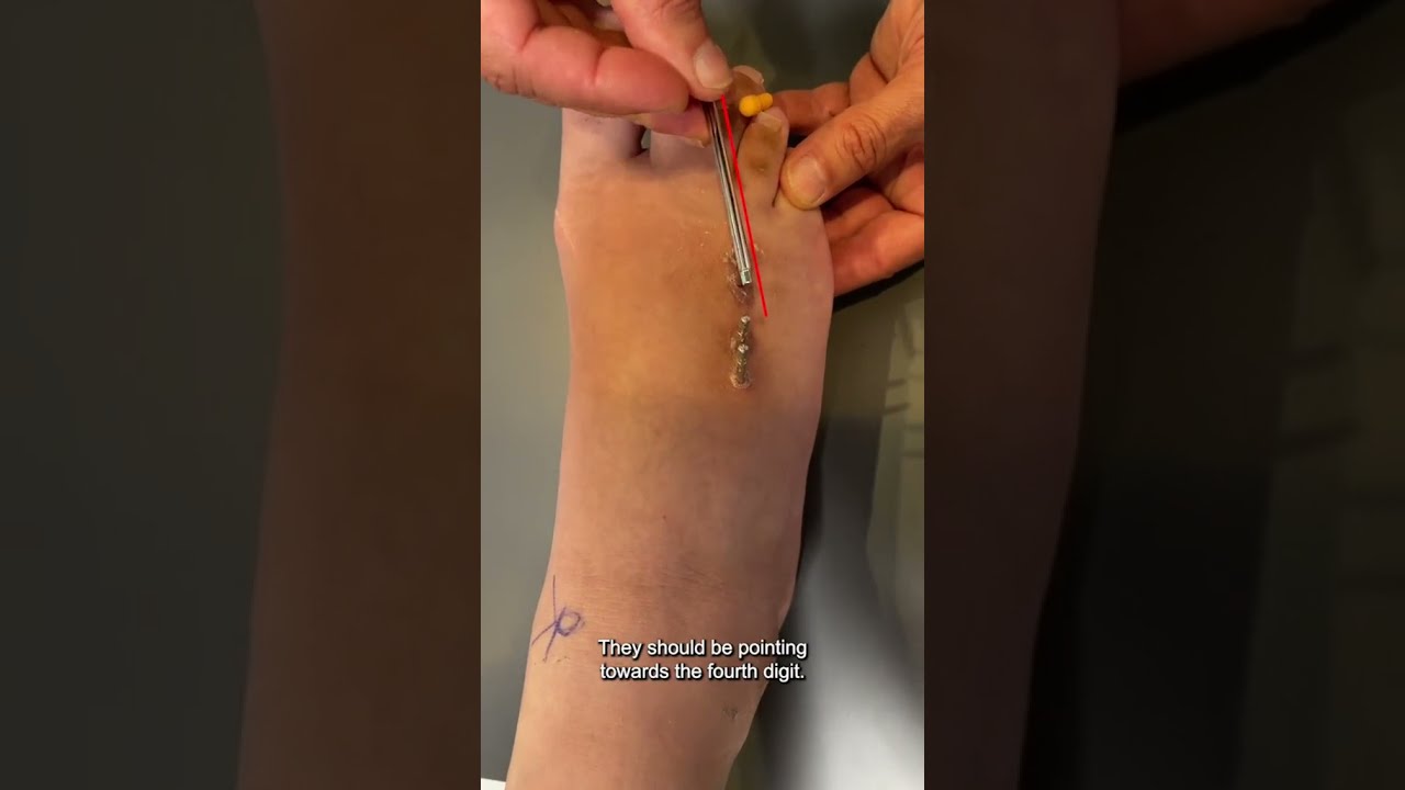 How I repaired a toe lengthening that went wrong