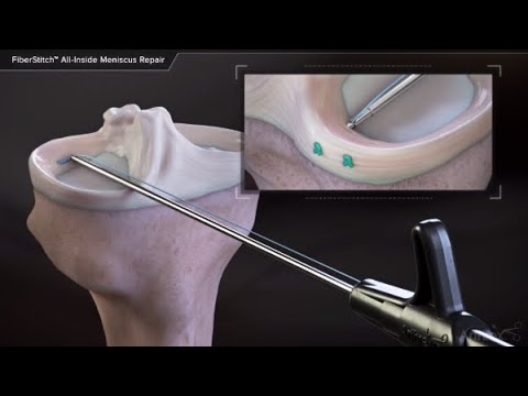 Meniscus Repair - Inside-Out Technique