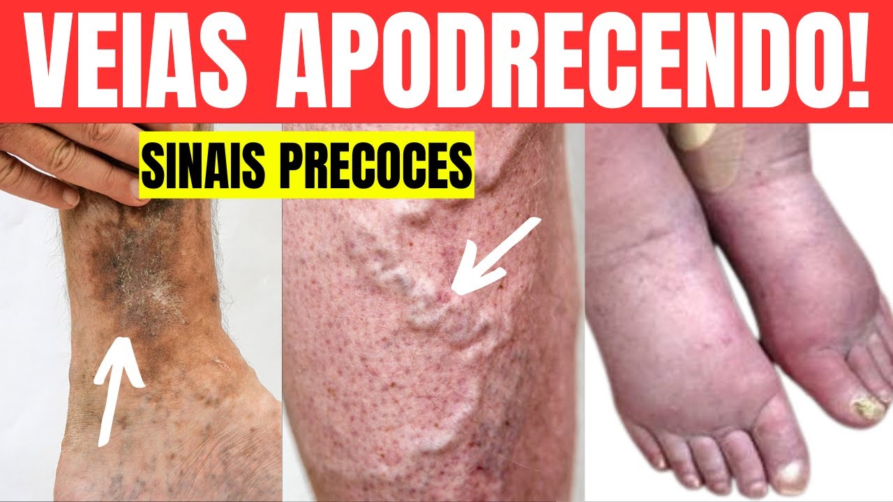 12 Strange Signs of VENOUS INSUFFICIENCY | Symptoms of POOR CIRCULATION