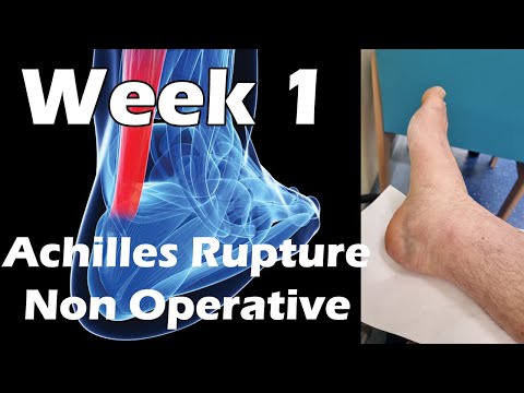Achilles Tear - Road To Recovery - Week1 Update - Non Surgical