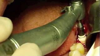 preview picture of video 'ZIRCONIA IMPLANTS Z-SYSTEM ENGLISH. DENTAL COSMETICS COSTA RICA'