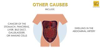 Abdominal Pain