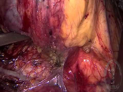 Partial Nephrectomy - Mobilization of Ureter