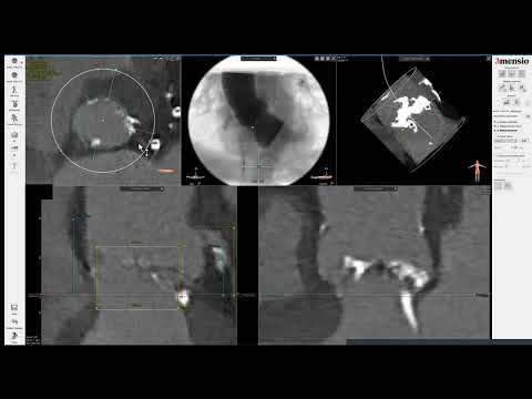 3Mensio CT pre-case planning: TAVR in Bicuspid Valve, Part 1