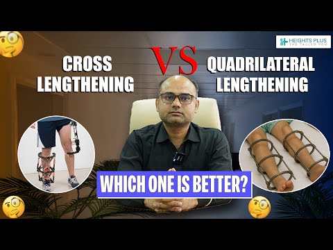 Cross vs. Bilateral Leg Lengthening: Best Surgery Method to Gain 13-15 cm Height