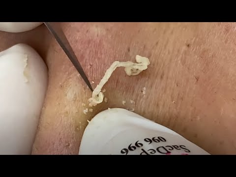 Most Blackheads I Have Ever Seen