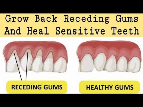 Heal Receding Gums And Grow Back | Treat Sensitive Teeths