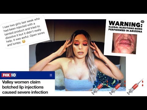 Maricopa Lip Fillers GONE WRONG!!! **I WAS THERE**