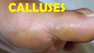 how to get rid of calluses on big toe