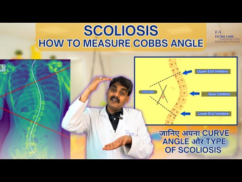 How to measure Cobb Angle | Scoliosis Measurement | Extra Care Lucknow