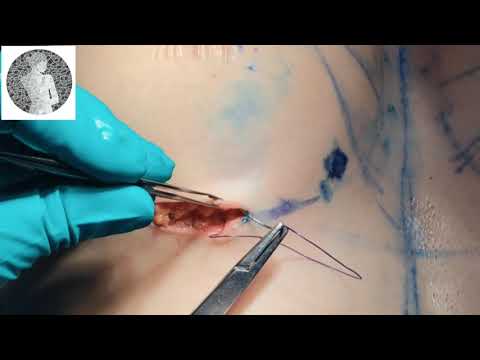 Sutiã Interno - Internal Bra- IMF wound closure with Barbed Suture (EDUCATIONAL VIDEO) Video