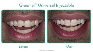 Gloss Retention - G-ænial™ Universal Injectable