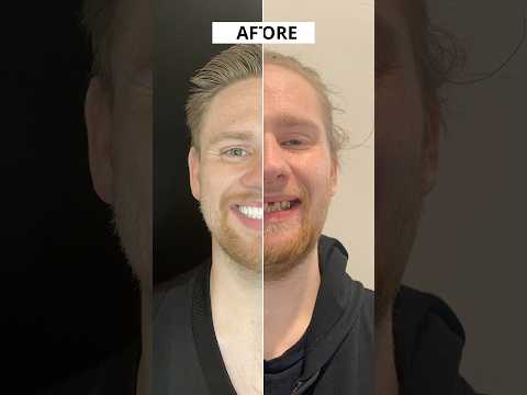 Before & After Dental Implants🤯😲😳#beforeandafter #shorts #allon4dentalimplants