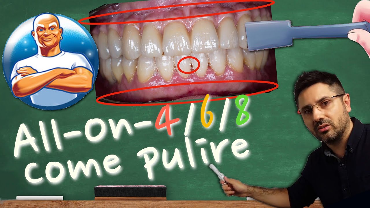 Watch Now Pulizia All-on-4 All-On-6 e Toronto Bridge | Ecco come pulirli a casa. Pulizia All-on-4 All-On-6 e Toronto Bridge | Ecco come pulirli a casa.