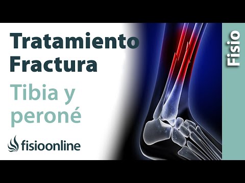 Fracture of the Tibia and Fibula: Treatment from the IMMOBILIZATION phase