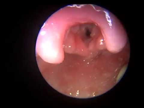 Squamous papilloma esophagus causes