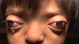 Girl with bulging eyes who bullies call 'frog' or 'alien' says she dreams of looking normal