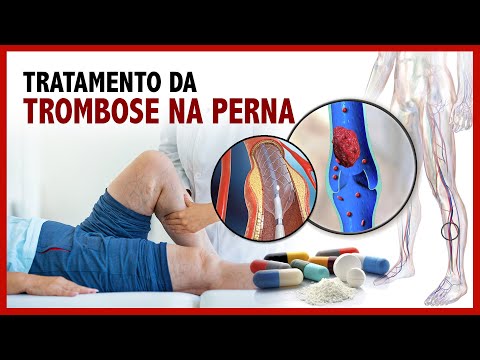 Tratamento da trombose na perna