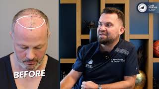 Smile Hair Clinic: 5700-Graft Transformation by Dr. Erdoğan