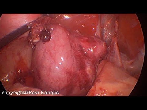 Laparoscopic Excision of Large Duodenal Duplication Cyst