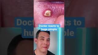 HUGE Painful Pimple on the￼ lip! | 208SkinDoc