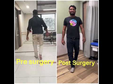 Endoscopic spine surgery Boon for Spine slip disc एंडोस्कोपिक सर्जरी: स्पाइन स्लिप डिस्क केलिए वरदान