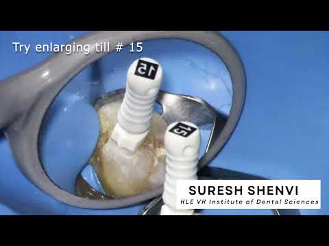 How to clean calcified canals | Microscopic Endodontics