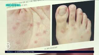 [G1뉴스] 영유아 수족구병 비상