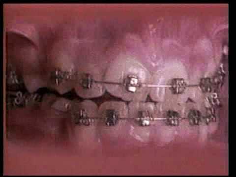 Straight teeth in under 60 seconds!