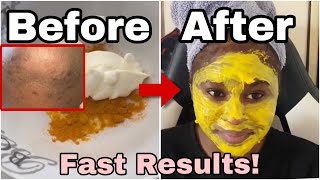 HOW TO GET RID OF DARK SPOTS FAST ON FACE