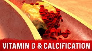 Vitamin D and Coronary Artery Calcification Explained by Dr.Berg