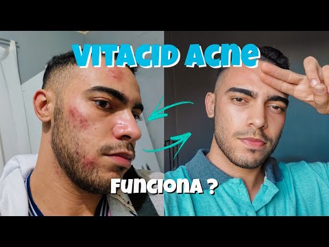 Como usar VITACID, ele Mancha a Pele? #tratamentodeacne