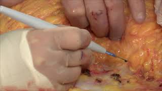 True Form Tummy Tuck (EN ESPAÑOL)