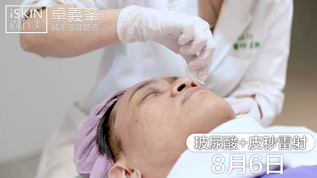 【UP雷射+4D皮秒+玻尿酸】聚光燈下的Superstar 卓義峯