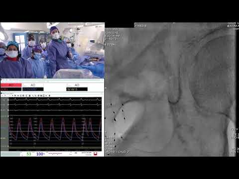 Evolut PRO Valve-in-Valve - Live Case 2