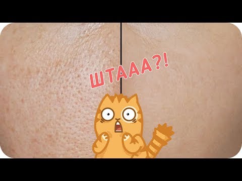 Корректоры пигментных пятен Удаление веснушек лазером до и после