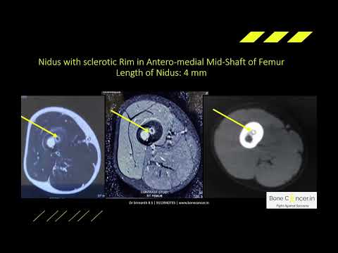 Osteoid Osteoma (Benign Bone Tumour): Symptoms, Signs & Treatment. Dr Srimanth B S