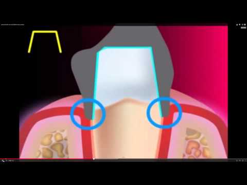 dunkler Rand bei Zahnkrone - wieso?