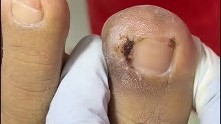Ep_8924 Ingrown toenail removal 👣 ดูชิ้นเล็บแล้ว..ต้องพี่เอื้อมถึงเอาออกได้ 😅 (clip from Thailand)