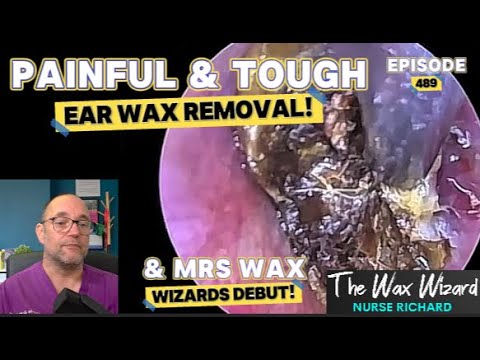 PAINFUL & TOUGH EAR WAX REMOVAL! Episode 489 (& Mrs Wax Wizards Debut!)
